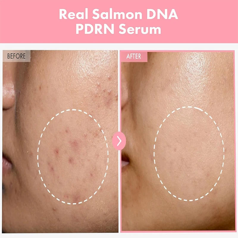 Sérum Anti-Acné Peptides & PDRN Collagène – Pores Affinés, Éclat & Teint Unifié
